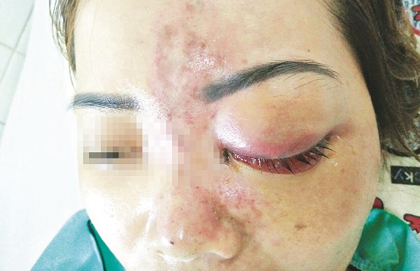 Tiêm Filler có thật sự ‘an toàn’?-dulichgiaitri.vn