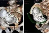 Chụp CT cho cụ bà 73 tuổi, bác sĩ sốc nặng khi phát hiện thai nhi hóa đá 30 năm