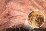 Ngứa mắt khó chịu, người bệnh sốc khi bác sĩ tìm thấy “thủ phạm” ở bờ mi