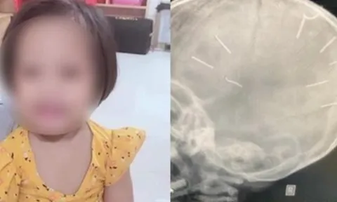 Bé gái 3 tuổi bị người tình của mẹ bắn đinh vào đầu đã tử vong