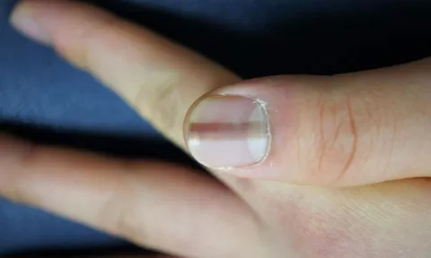Những bất thường trên móng tay có thể là cảnh báo sớm của bệnh tật