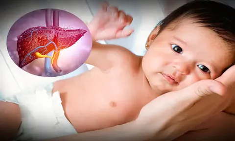 Bệnh viêm gan lạ ở trẻ em: Mối lo ngại lớn