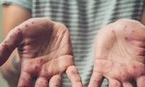 WHO và các chuyên gia y tế khuyến cáo cách phòng bệnh đậu mùa khỉ