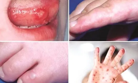 Cảnh báo bệnh tay chân miệng vào mùa