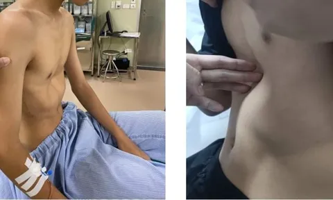 Nam bệnh nhân bị suy dinh dưỡng, cong vẹo cột sống vì... lõm ngực bẩm sinh
