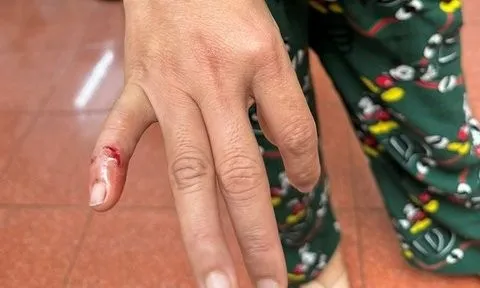 Con chó lạ tấn công người dân ở phố núi dương tính với vi rút dại