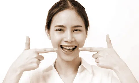 Niềng răng và lưu ý chăm sóc răng miệng