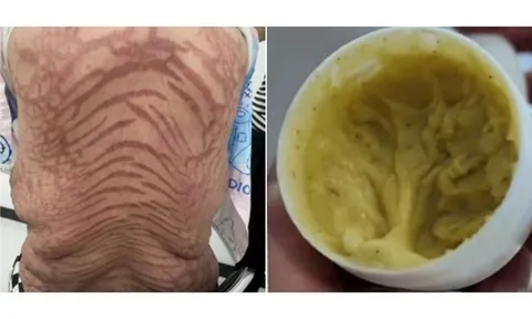 Buồn nôn, tê tay, người phụ nữ xuất hiện thứ "đáng sợ" trên lưng