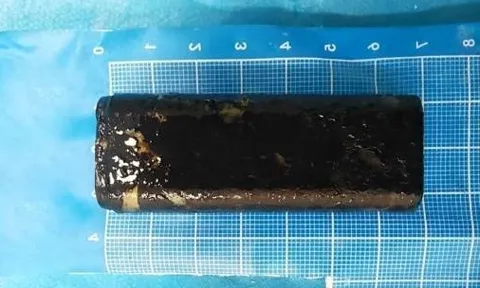 Người đàn ông đau bụng dữ dội, bác sĩ gắp ra thứ "đáng sợ"