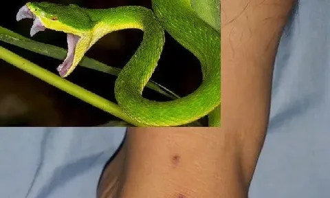 Bị rắn cắn, người đàn ông nguy kịch do tự đắp thuốc để "hút độc"