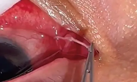 Người phụ nữ đau mắt đi khám, bác sĩ gắp ra thứ "đáng sợ" bên trong