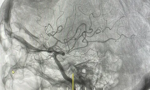 Cấp cứu thành công bệnh nhân đột quỵ não do tắc động mạch não giữa bằng kỹ thuật hút huyết khối