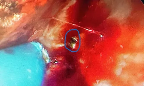 Bệnh viện Hữu nghị phẫu thuật thành công ca dị vật vách ngăn mũi tồn dư hơn 40 năm