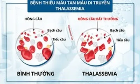 Bệnh tan máu bẩm sinh: Bệnh di truyền lặn nhưng phổ biến nhất ở Việt Nam và thế giới