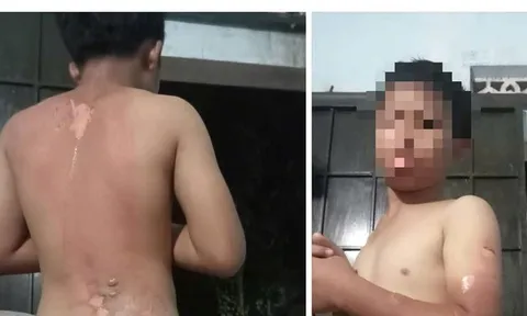 Công an vào cuộc vụ mẹ tạt nước sôi lên người con trai