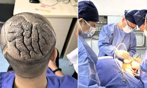 Người đàn ông 23 tuổi có da đầu dày, gấp nếp như bộ não và sự thật bất ngờ