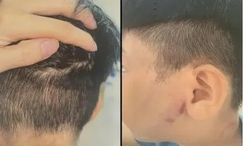 Triệu tập người cha vụ bé trai 8 tuổi nghi bị bạo hành phải nhập viện cấp cứu
