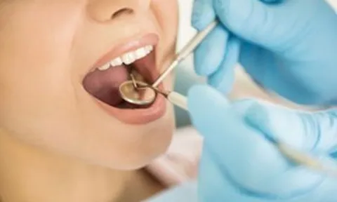Lấy cao răng có được hưởng bảo hiểm y tế?