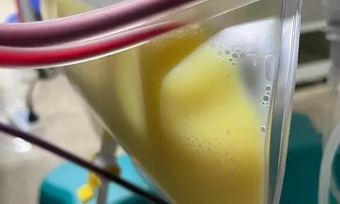 Người phụ nữ 30 tuổi "máu trắng đục như sữa" vì thói quen nhiều người mắc mà không hay