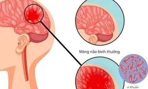 Bệnh não mô cầu có thể gây tử vong nhanh, chuyên gia cảnh báo những dấu hiệu nguy hiểm
