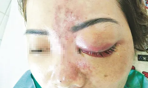 Tiêm Filler có thật sự an toàn?