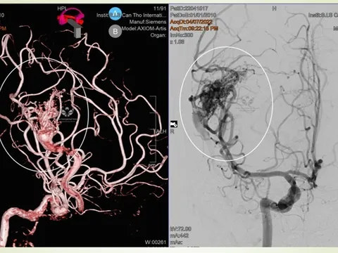Bé gái 10 tuổi nguy kịch vì đột quỵ, chuyên gia cảnh báo điều quan trọng