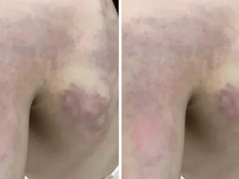 Xác minh nghi vấn giáo viên đánh học sinh lớp 3 bầm tím vì...không thuộc bài