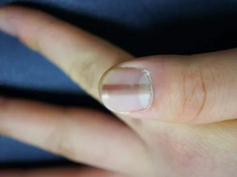 Những bất thường trên móng tay có thể là cảnh báo sớm của bệnh tật