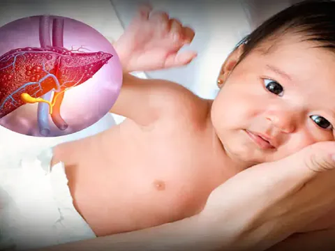 Bệnh viêm gan lạ ở trẻ em: Mối lo ngại lớn