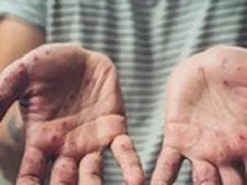 WHO và các chuyên gia y tế khuyến cáo cách phòng bệnh đậu mùa khỉ