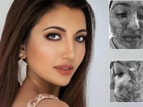 Á hậu Miss World 2021 từng bị biến dạng mặt, ngắm dung nhan hiện tại ai cũng cảm phục