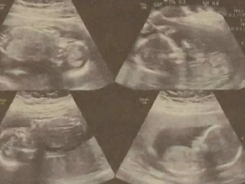 Cô gái sinh 2 con cách nhau 4 ngày, vẫn còn 2 thai nhi trong bụng