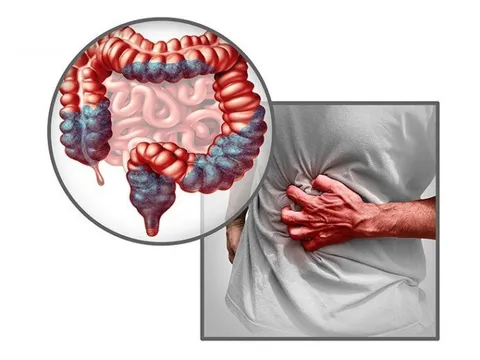 Hội chứng ruột kích thích: Nguyên nhân và giải pháp từ Đại tràng Á Âu