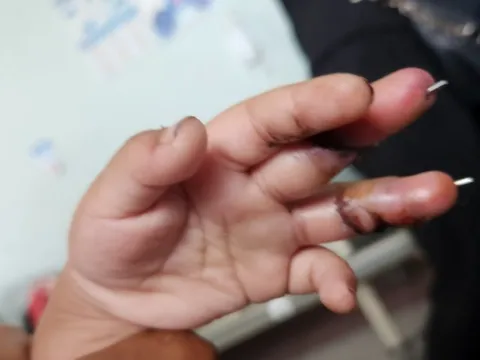 Nối thành công ngón tay đứt lìa cho bệnh nhi 3 tuổi bị quạt chém