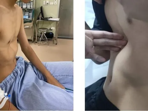 Nam bệnh nhân bị suy dinh dưỡng, cong vẹo cột sống vì... lõm ngực bẩm sinh