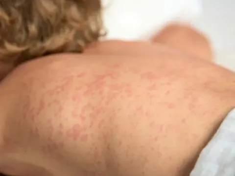 Tp.HCM: Lo ngại nguy cơ những bệnh truyền nhiễm nguy hiểm hoành hành