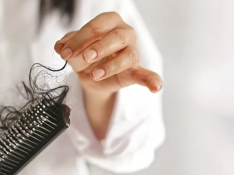 Lưu ý khi điều trị rụng tóc