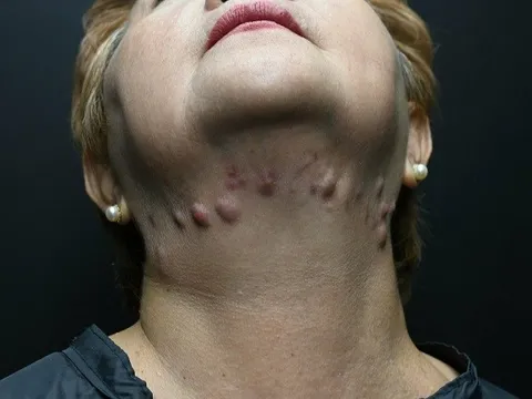 “Tiền mất, tật mang” vì tiêm tan mỡ nọng cằm