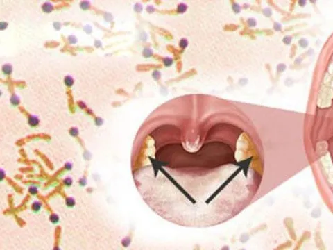 Ghi nhận ca tử vong do bệnh bạch hầu