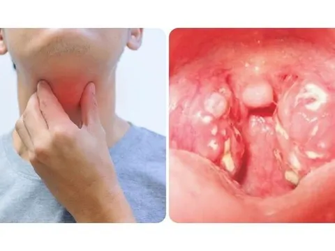 Bệnh bạch hầu vẫn trong tầm kiểm soát