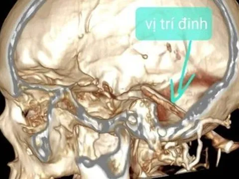 Người đàn ông bị cây đinh đâm vào não suốt một năm