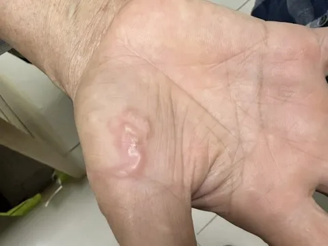 Cảnh báo nguy cơ mắc giun đũa do nuôi chó, mèo