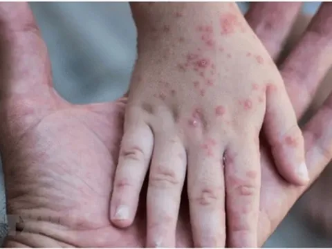 Tăng cường giám sát, phát hiện các ca nghi ngờ bệnh đậu mùa khỉ