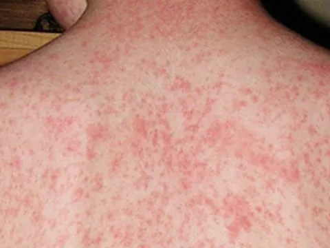 Ưu tiên tiêm vaccine sởi cho 18 tỉnh, thành nguy cơ cao