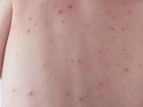 TPHCM công bố dịch sởi