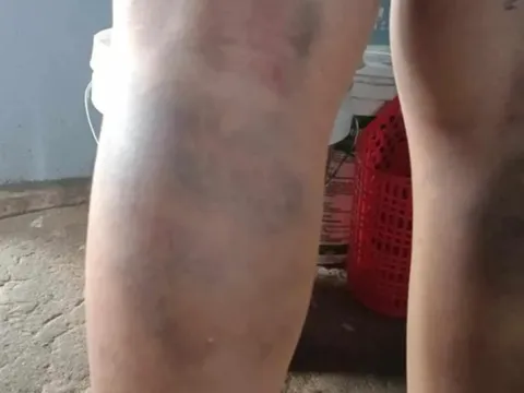 Đánh học sinh lớp 6 bầm tím 2 chân, cô giáo chủ nhiệm bị đình chỉ công tác