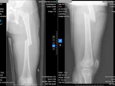 BV Nhi Hà Hội: Phẫu thuật thành công bằng phương pháp xâm lấn tối thiểu cho bệnh nhi 7 tuổi