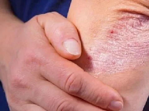 Có nên tự dùng thuốc để chữa bệnh vảy nến?