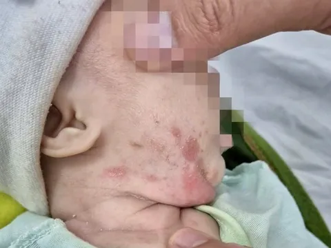 Bé 2 tháng tuổi mắc giang mai, cả bố mẹ đều bị mà không biết