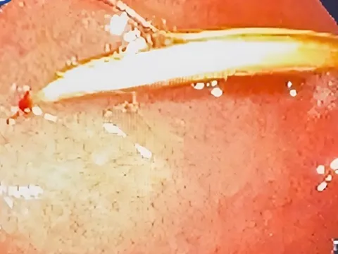 Cụ ông 71 tuổi thủng tá tràng vì thói quen xấu "khó bỏ"